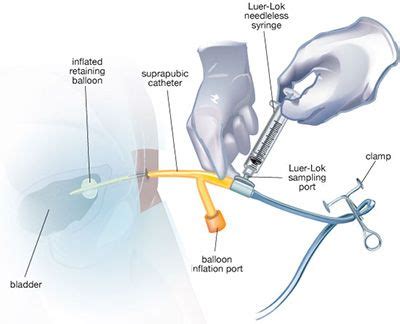 Urinary Catheter Care (With images) | Catheter, Urinary catheterization ...