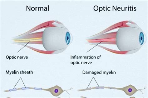 Symptoms, Causes, Treatments of Optic Neuritis - The Eye News