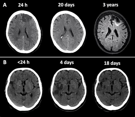 Brain Infarct Segmentation and Registration on MRI or CT for Lesion ...