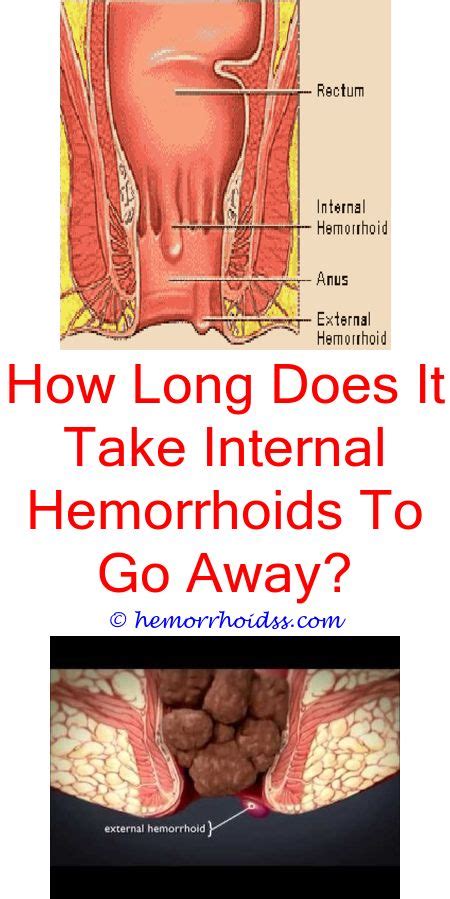 Are Hemorrhoids Hard Or Soft? | Bleeding hemorrhoids, Hemorrhoid ...