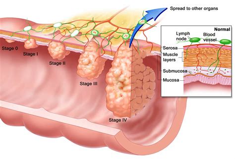 Esophageal Cancer - Causes, Signs, Symptoms, Treatment