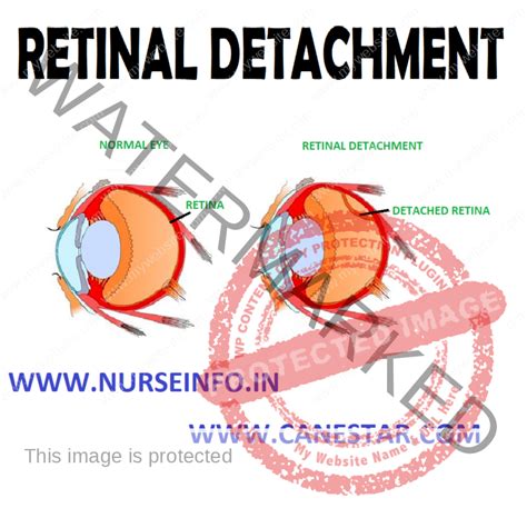 RETINAL DETACHMENT - Nurse Info