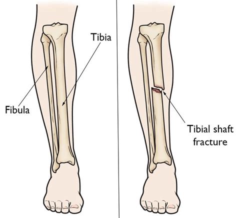 Tibial shaft fracture causes, types, symptoms, diagnosis, treatment ...