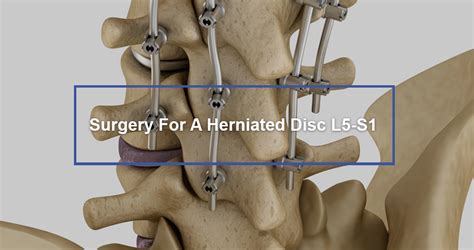 Surgery For A Herniated Disc L5-S1 - Dr. Kevin Pauza, The Discseel ...