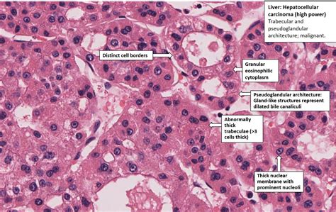 Liver – Hepatocellular Carcinoma – NUS Pathweb :: NUS Pathweb