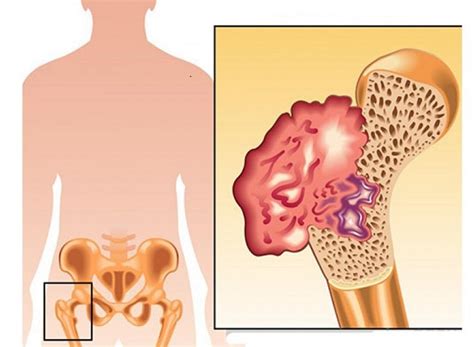 Síntomas del cáncer de huesos - Esqueleto humano