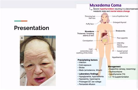 Periorbital Edema Hypothyroidism