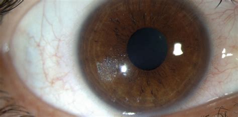 MBS item for corneal foreign body removal a step closer - Optometry ...