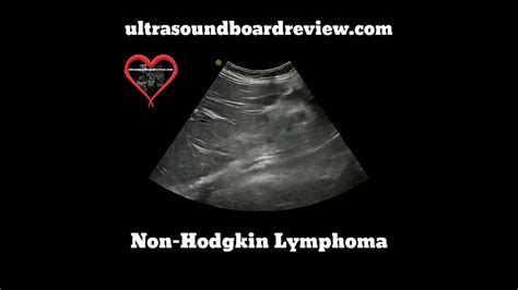 Non-Hodgkin Lymphoma Ultrasound - YouTube