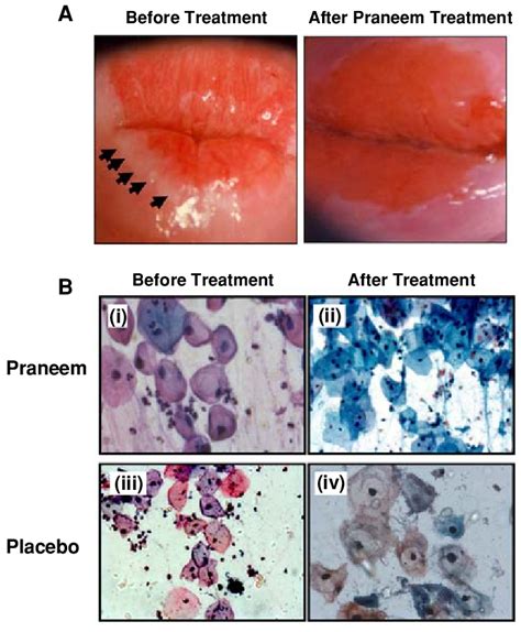 a Representative colposcopy photographs showing regression of ...