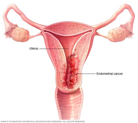 Endometrial cancer - Symptoms and causes - Mayo Clinic