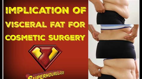 Visceral fat surgery - Hourglass Tummy Tuck