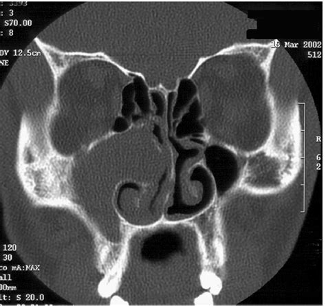 Coronal CT scan, bone windows, soft tissue mass obstructing the right ...