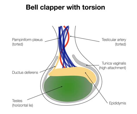 Bell Clapper Deformity Of The Testes: Causes and Treatment