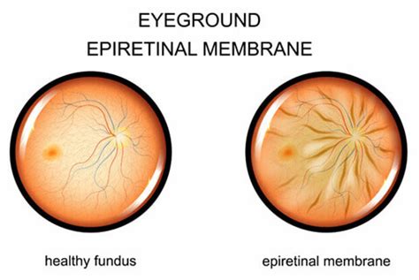 What is Epiretinal Membrane (ERM)? | Mann Eye Institute Houston