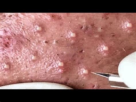 Introduction to Enilsa Advanced Acne System - Pimple Popping Videos