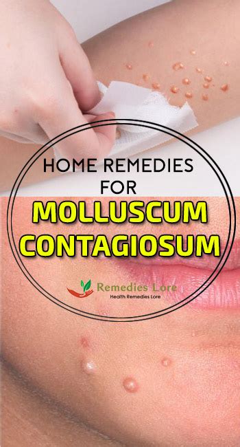 Home Remedies for Molluscum Contagiosum - Remedies Lore