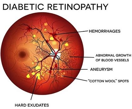 Monocytes in Diabetic Retinopathy Pathogenesis