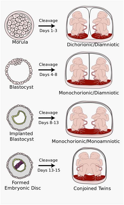 Monochorionic Diamniotic Twins, HD Png Download , Transparent Png Image ...