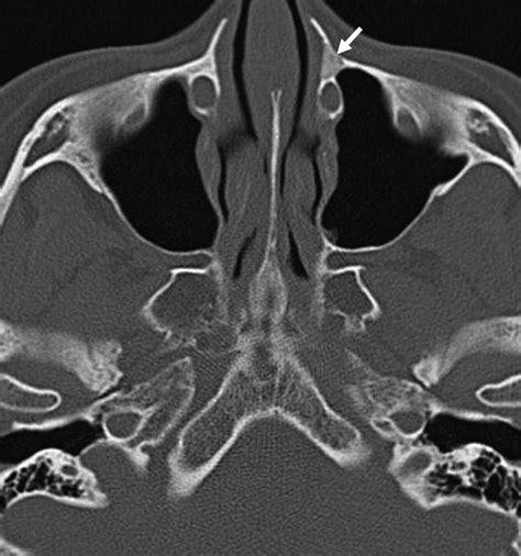 Frontal Process Of Maxilla Fracture