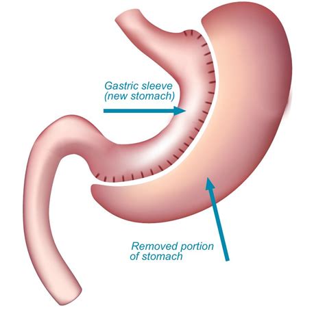 Gastric Sleeve Surgery Perth | Weight Loss - Bariatric Surgeons