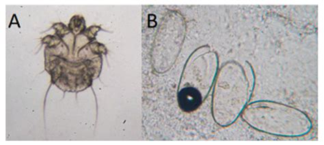 Scabies Eggs Under Microscope