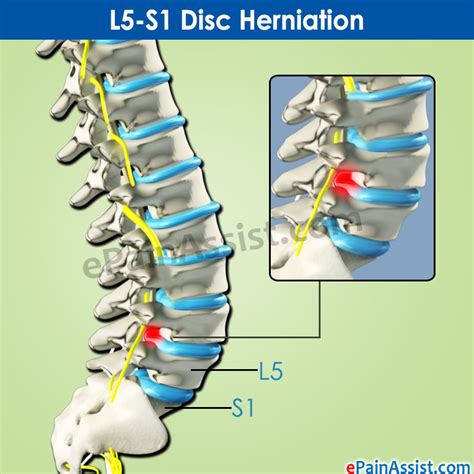 L5-S1 Disc Herniation: What is the treatment and recovery period?