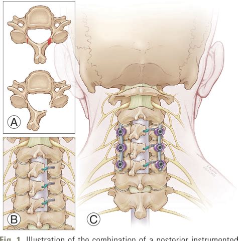 Figure 2 from Combined Laminoplasty and Posterior Fusion for Cervical ...