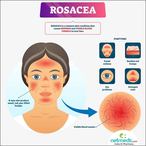 Rosacea: Causes, Symptoms And Treatment | Netmeds