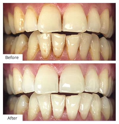 Teeth Cleaning Before And After