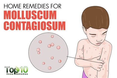 Home Remedies for Molluscum Contagiosum | Top 10 Home Remedies