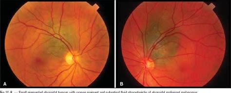 Figure 1 from Choroidal melanoma: natural history and management ...