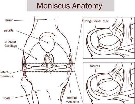 Meniscus Tear Rehab