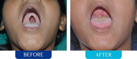 CLEFT LIP & PALATE SURGERY – Face Surgery Centre