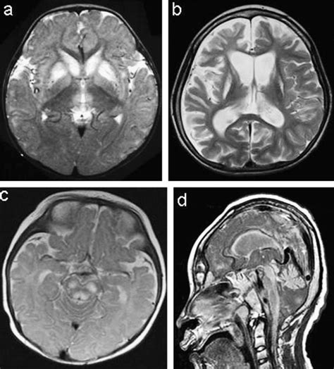 Leigh Syndrome: Clinical and Neuroimaging Follow-Up - Pediatric Neurology