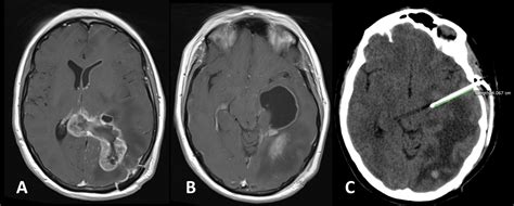 Management Options in Patients with Trapped Temporal Horn: Case Report ...