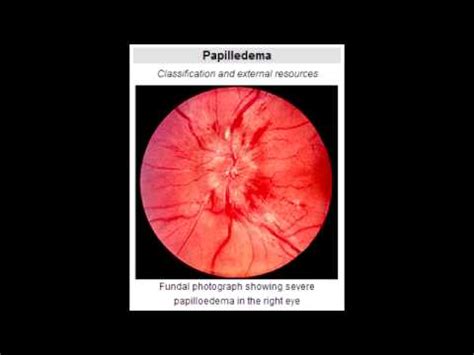 Papilledema - Define & Causes - YouTube