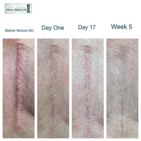 My Dad's Open Heart Surgery Scar on Nerium AD. Go to DebbyLoves.Nerium ...