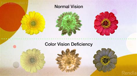 Color Blindness - Causes And Diagnosis | Fort Lauderdale Eye Institute