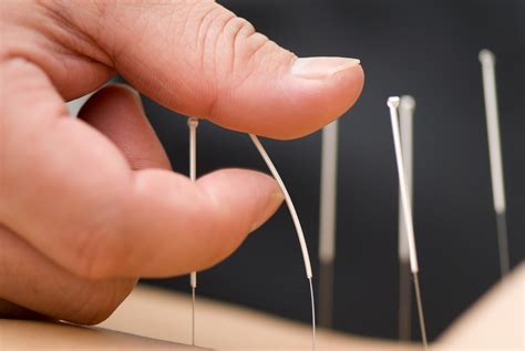 What Does Acupuncture Feel Like?