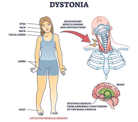 Cervical dystonia and spasmodic torticollis treatment