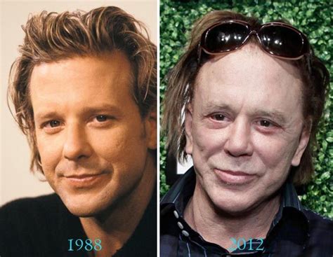 Mickey Rourke Plastic Surgery Before And After