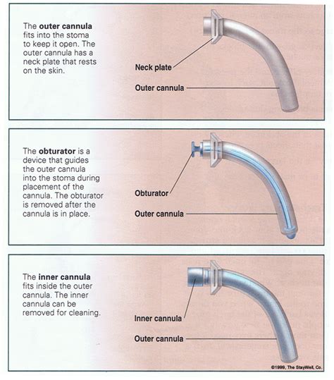 Clinical Focus: Trach Tubes