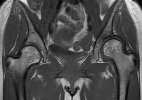 MRI in Hip Dysplasia: How to Shorten your MR-Protocol? | Hip dysplasia ...