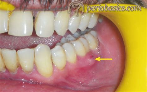 Absceso Periodontal