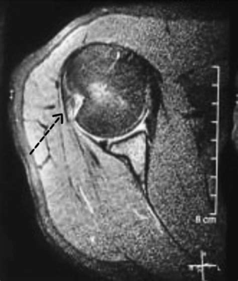 Pre-operative MRI showing Hill Sachs lesion. | Download Scientific Diagram