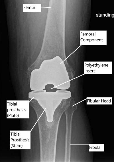 Total Knee Replacement Recovery Guide | Complete Orthopedics | Multiple ...