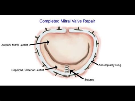 How Long Will My Annuloplasty Ring Last After Mitral Valve Repair ...