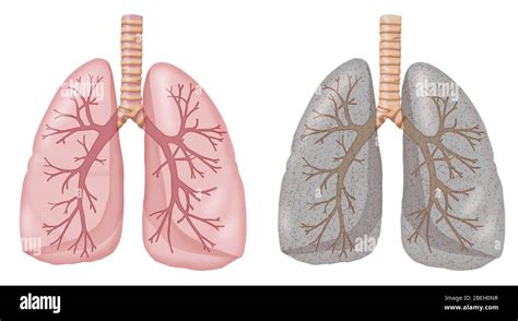 Non Smoker Lungs Vs Smoker