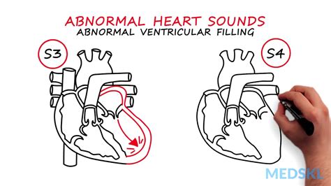 Abnormal Heartsounds and Murmurs: Which heart sounds should worry you ...